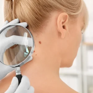 What You Need to Know About Skin Cancer