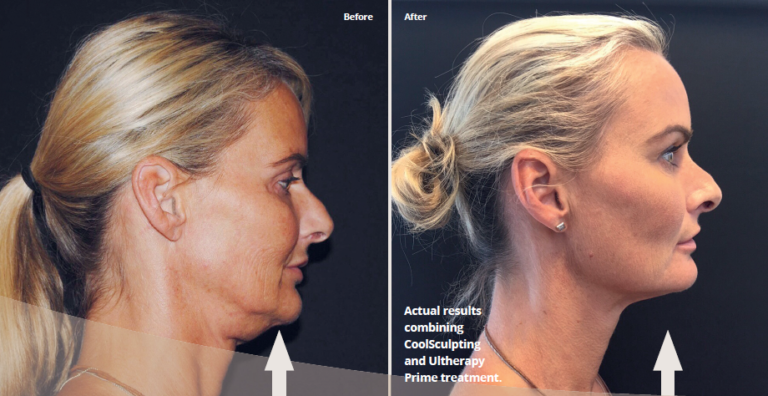 iBeauty – Real lasting results with Ultherapy Prime