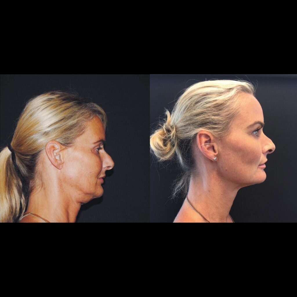 Turning back the clock with ULTHERAPY PRIME