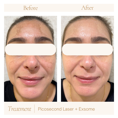 Have you heard of Exosomes – Skin Rejuvination at iBeauty