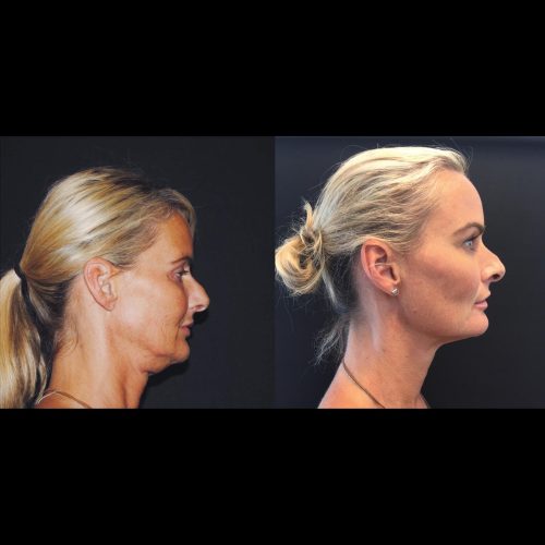 TURNING BACK THE CLOCK  WITH ULTHERAPY PRIME
